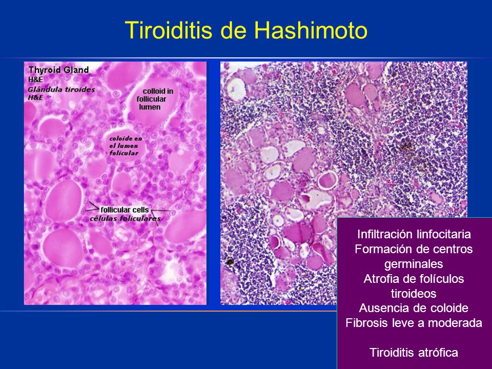 La dieta curativa para la tiroiditis de hashimoto pdf